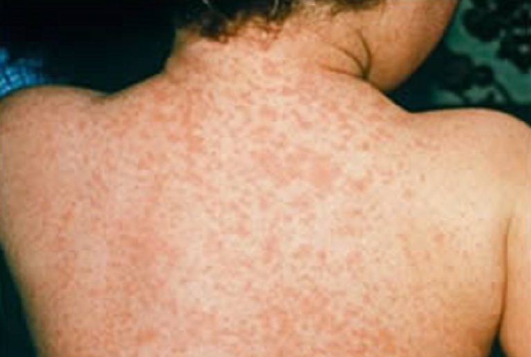 Morbillo, Lazio seconda regione per incidenza. D’Amato: “Calo della copertura vaccinale”